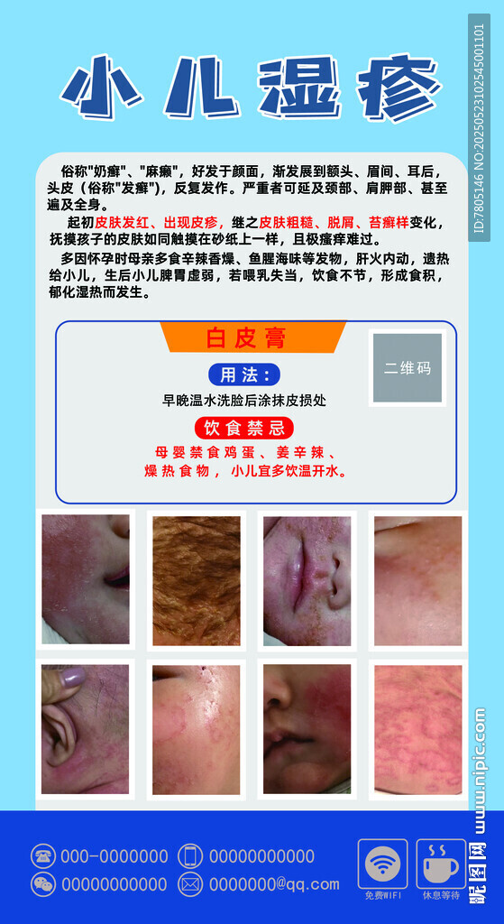 小儿湿疹治疗