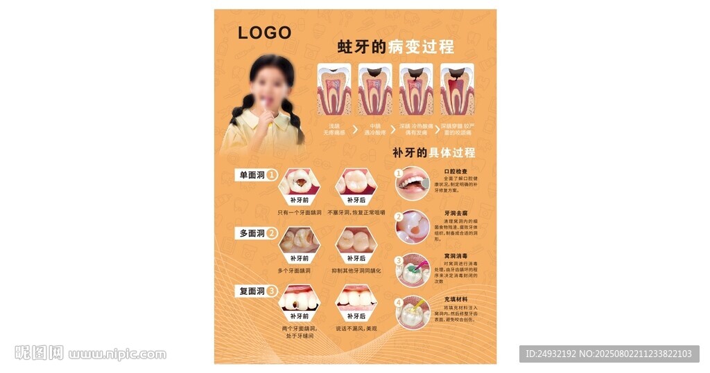 蛀牙的病变过程补牙的具体过程