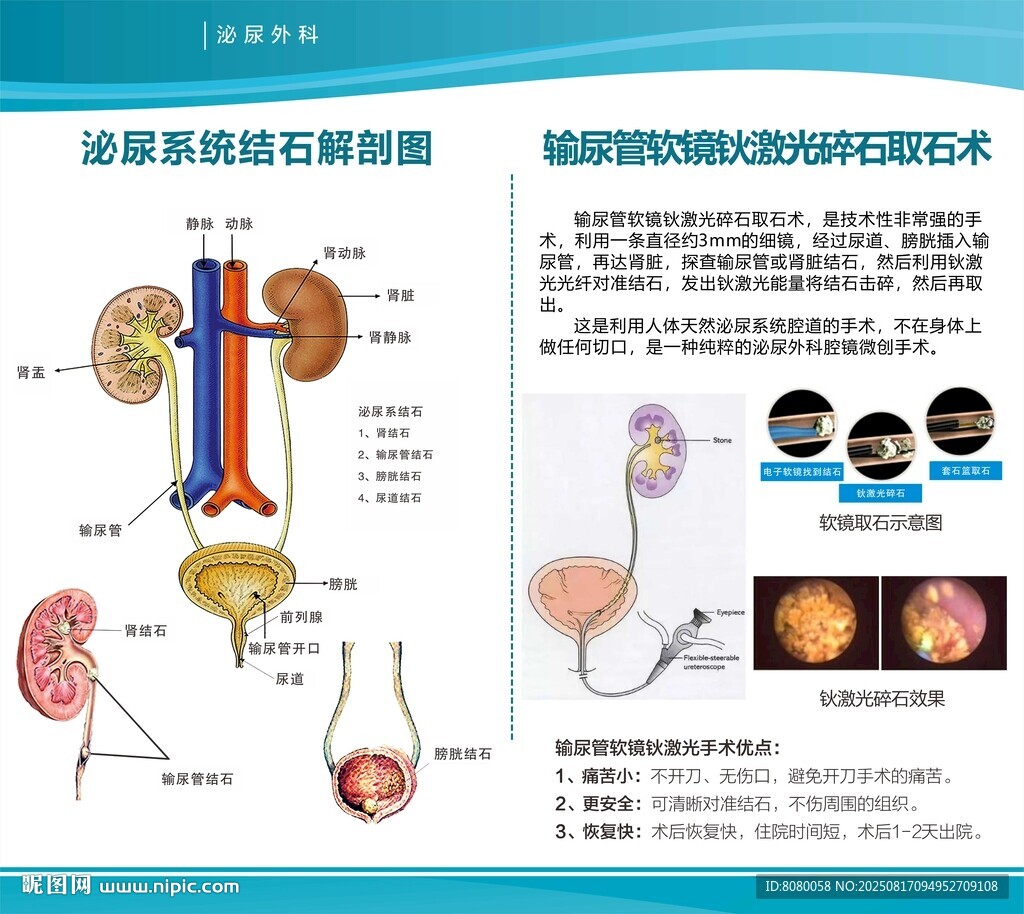 输尿管软镜钬激光碎石取石术