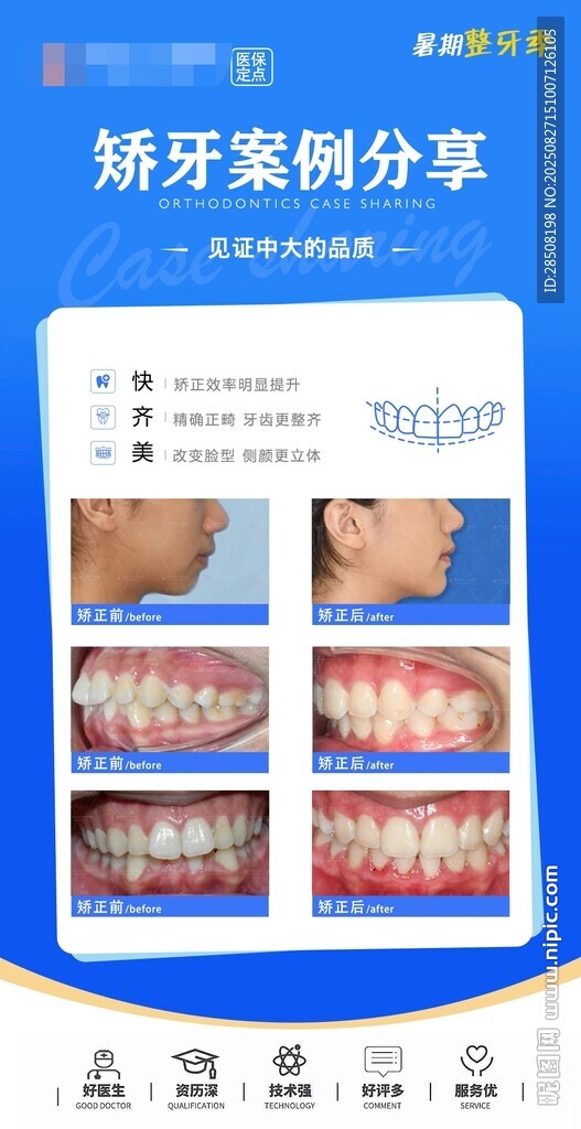 矫正牙齿案例分享