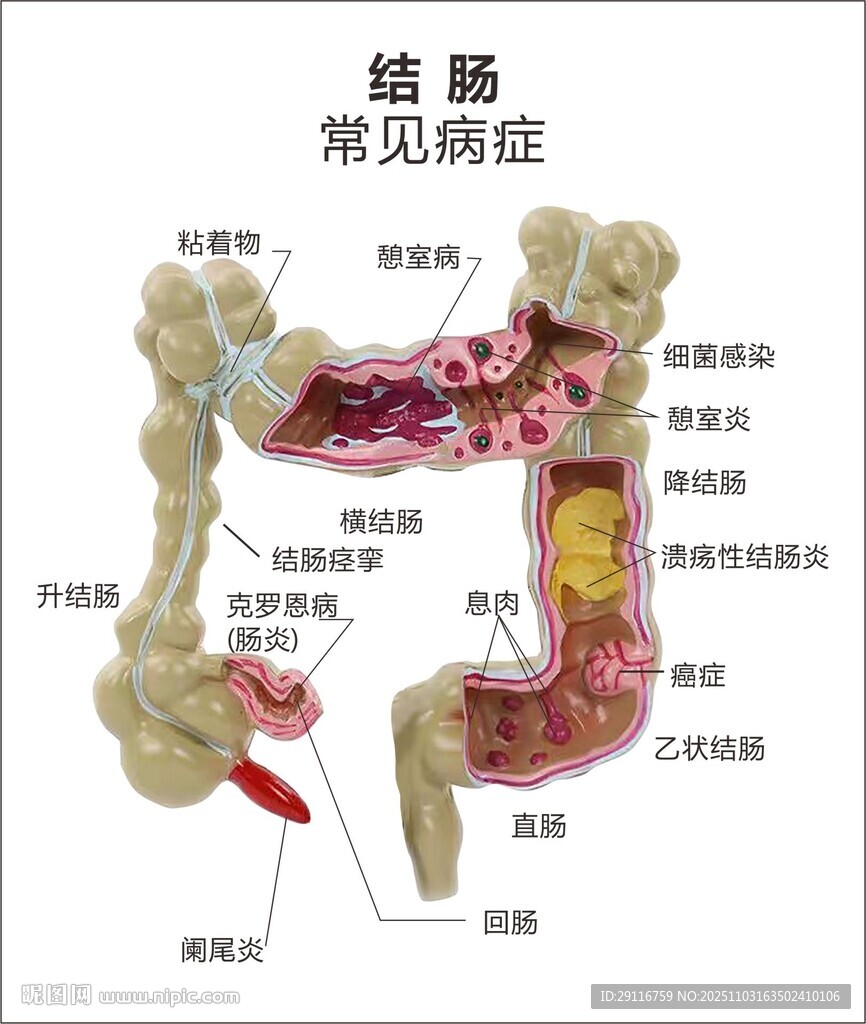 结肠常见病症解剖示意图