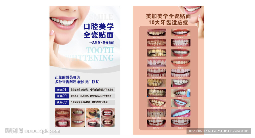 牙齿贴面10大牙齿适应症 