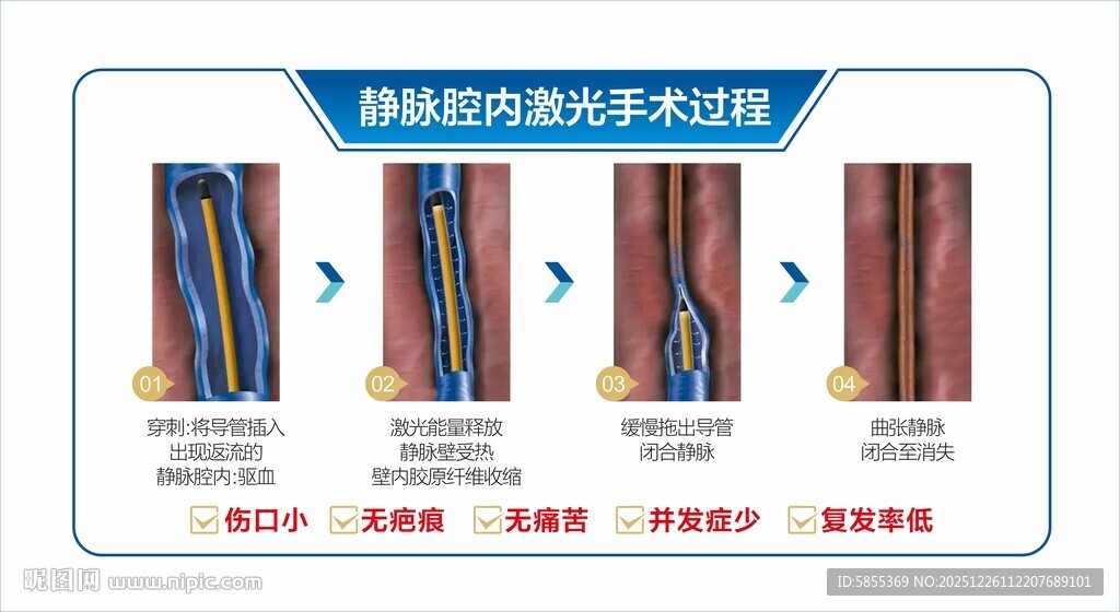 静脉曲张激光治疗