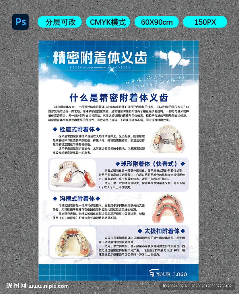 精密附着体义牙