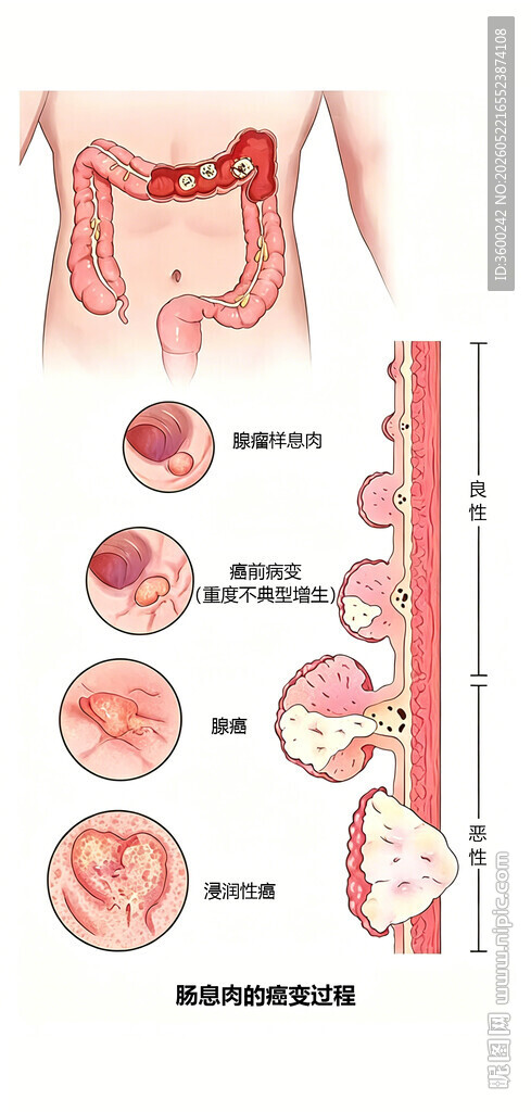 大肠息肉癌变演变图片