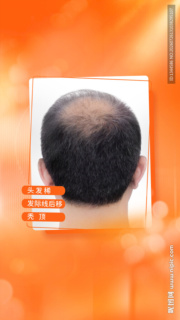男性头顶脱发问题展示