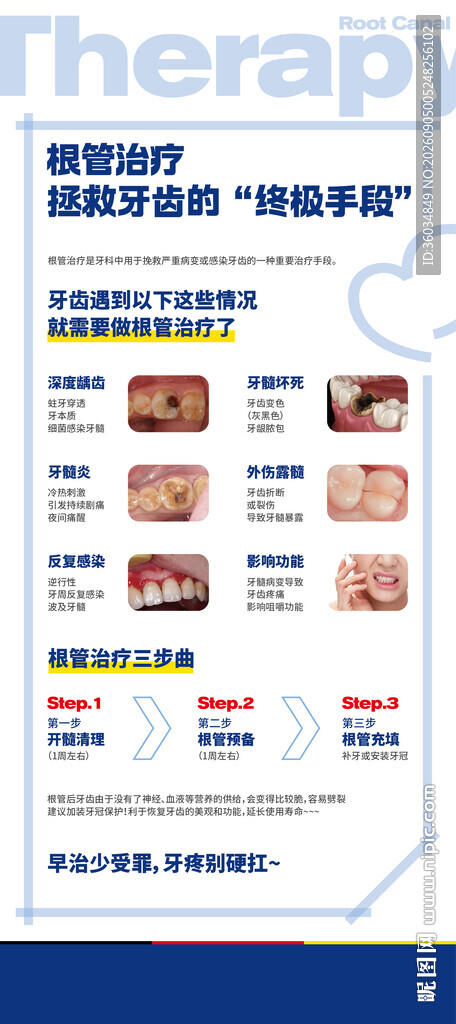 牙齿根管治疗科普