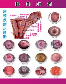 宫颈疾病