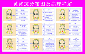 黄褐斑分布图