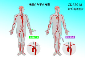 桡动脉入路神经介入手术