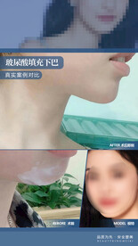 玻尿酸填充下巴