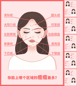 痘痘分布图分层