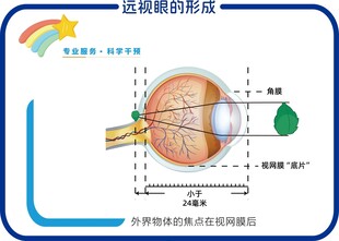 远视眼的形成